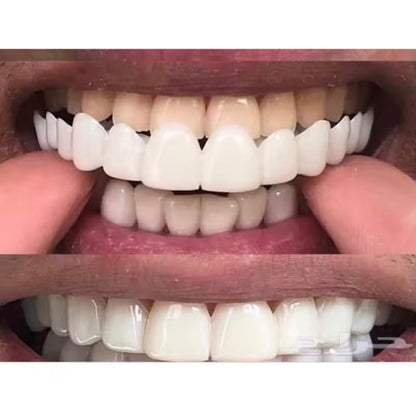 Carillas dentales 🦷